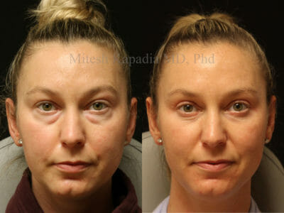 Woman in her early 40s before and after upper and lower blepharoplasty surgery, showing a rejuvenated and refreshed look
