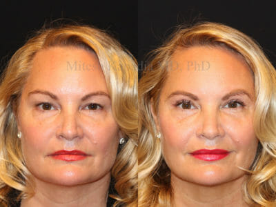 Woman in her early 50s before and after upper blepharoplasty surgery, revealing a more youthful, and less tired appearance