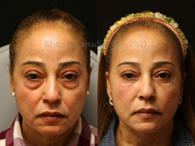 Woman in her early 50s before and after lower blepharoplasty and upper nasal fat pad removal surgery with filler injections done during the post operative period. She appears more youthful and refreshed after her procedures