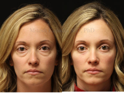 Woman in her late 30s before and after lower eyelid and upper nasal fat pad removal surgery revealing a refreshed, less tired look