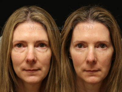 Woman in her late 50s before and after lower blepharoplasty surgery, revealing a less tired and refreshed look