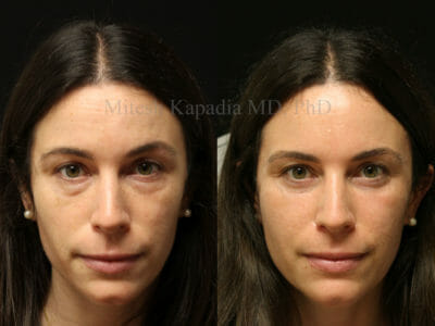 Woman in her mid-30s before and after lower blepharoplasty surgery with lower eyelid CO2 laser resurfacing, resulting in a vibrant and refreshed look