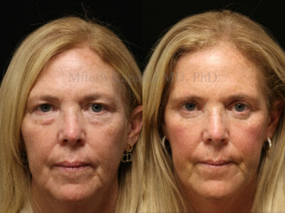 Woman in her early 60s before and after upper and lower blepharoplasty surgery, resulting in a rejuvenated and more youthful appearance