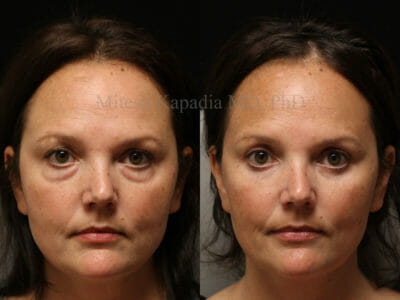 Woman in her mid-40s before and two months after lower blepharoplasty surgery revealing a vibrant and refreshed look
