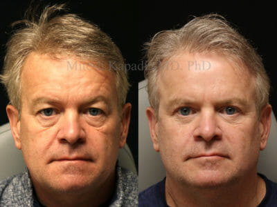 Man in his early 50s before and after upper and lower blepharoplasty surgery showing a refreshed and more youthful appearance
