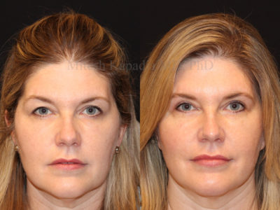 These photos show a woman in her mid-50s before and after upper eyelid surgery, revealing a subtle tweak to the eyelids and a happier, refreshed appearance