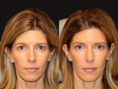 Woman in her mid-40s before and two months after upper blepharoplasty surgery displaying a vibrant and refreshed result
