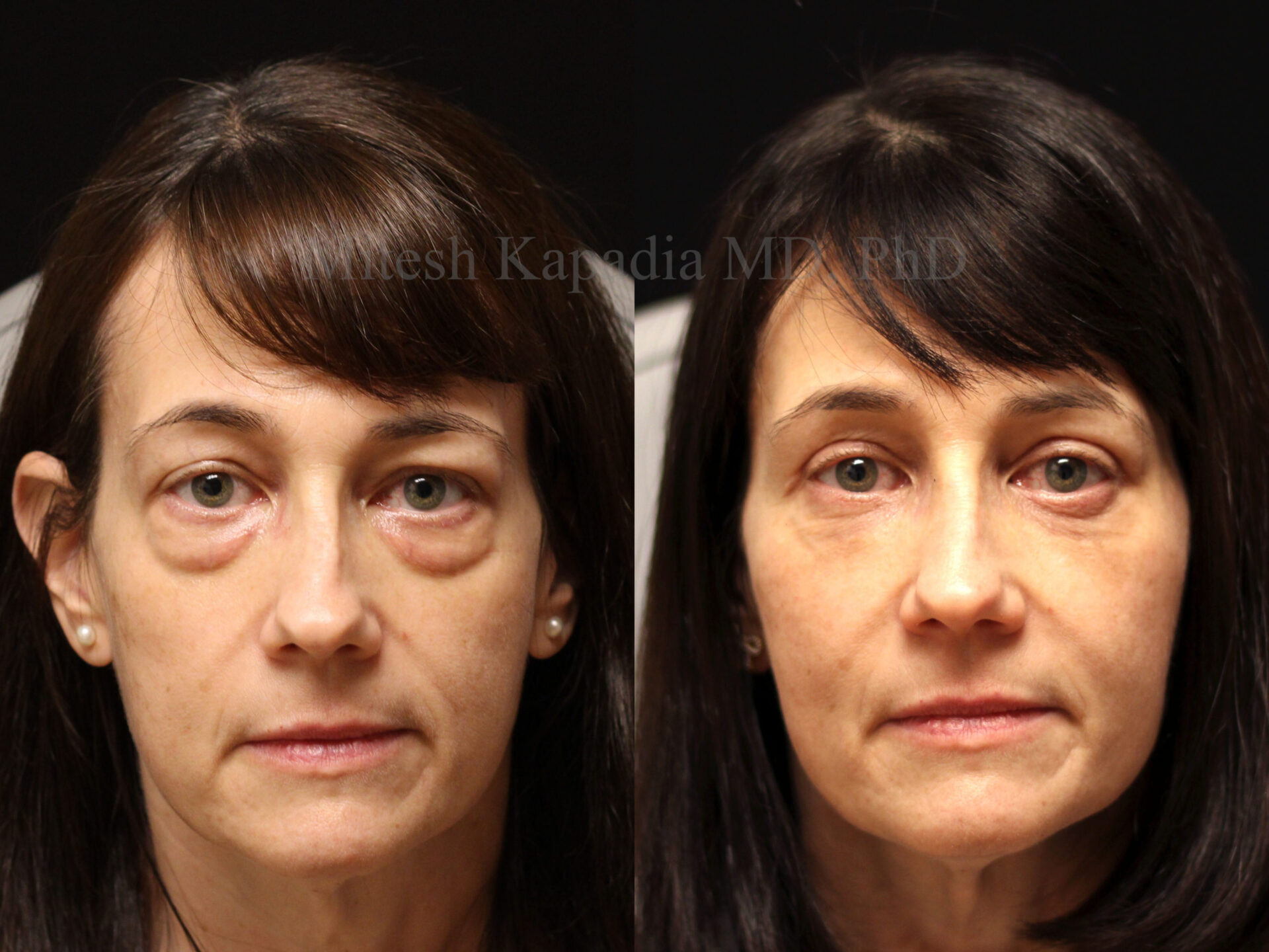 Before And Six Months After Upper And Lower Blepharoplasty Surgery 