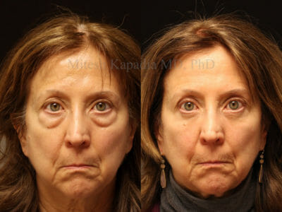 Woman in her mid-60s before and after lower blepharoplasty surgery, showing a rejuvenated, more youthful look
