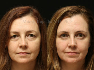 Woman in her late 40s before and after upper and lower blepharoplasty surgery displaying a well rested and rejuvenated look