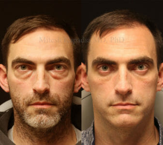 Man in his late 30s before and after lower eyelid surgery, revealing a refreshed and well rested look