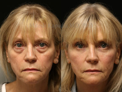 Woman in her early 60s before and after lower eyelid surgery, along with midface filler injections done in the post operative period, revealing a refreshed and more youthful look