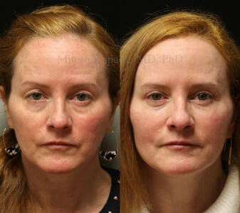 Woman in her early 50s before and after upper eyelid surgery and lower eyelid filler injections, revealing a radiant and more youthful appearance