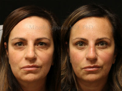Woman in her mid-40s before and after upper and lower eyelid surgery, displaying a naturally refreshed and well rested appearance
