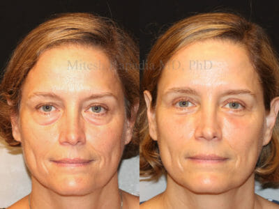 Woman in her mid-50s before and after upper and lower eyelid surgery, showing a refreshed and well rested appearance