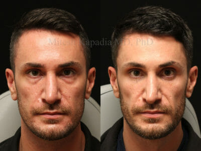Man in his early 30s before and after lower eyelid surgery, revealing a well rested and refreshed appearance