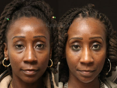Woman in her mid-30s before and after lower eyelid surgery, showing a younger, well rested look