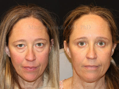 Woman in her early 50s before and after upper and lower eyelid surgery with lower eyelid CO2 laser skin resurfacing, revealing a radiant, more youthful and refreshed appearance