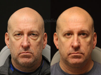 Man in his late 40s after upper and lower blepharoplasty surgery, revealing a well rested and refreshed appearance