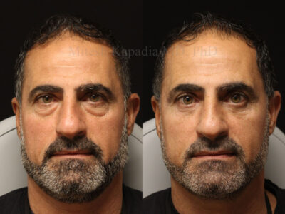 Man in his 50s before and four months after lower blepharoplasty surgery giving him a vibrant, less-tired look