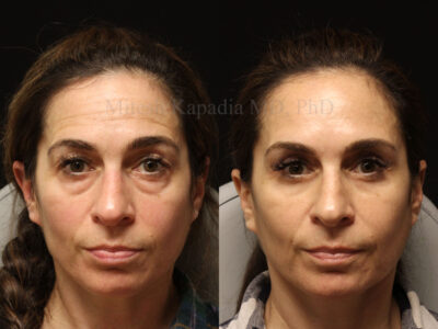 Woman in her 40s before and seven months after upper and lower blepharoplasty surgery - giving her a refreshed appearance