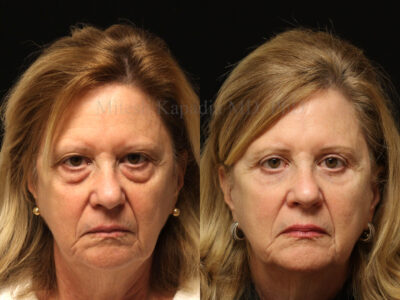 Woman in her 60s before and seven months after upper and lower blepharoplasty surgery with lower eyelid CO2 laser resurfacing