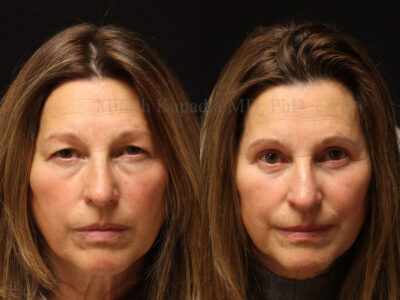 Woman in her 60s before and ten months after upper and lower blepharoplasty surgery giving her a refreshed look