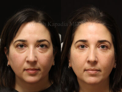 Woman in her 40s before and six months after upper and lower blepharoplasty surgery giving her a well rested, vibrant appearance
