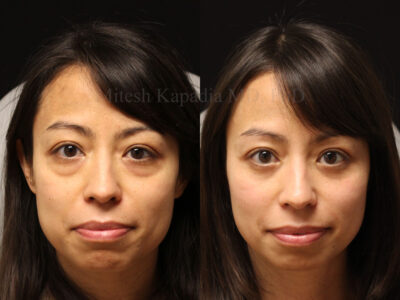 Woman in her 40s before and six months after lower blepharoplasty surgery leaving her with a vibrant, refreshed look