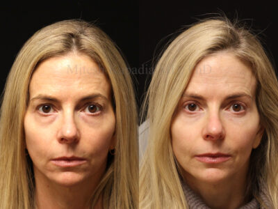 Woman in her 50s before and three months after upper and lower blepharoplasty surgery giving her a youthful, well rested appearance