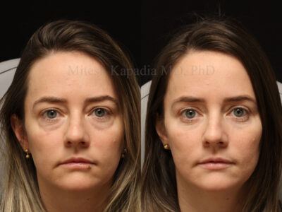 Woman in her 30s before and seven months after lower blepharoplasty surgery giving her a well rested, natural appearance