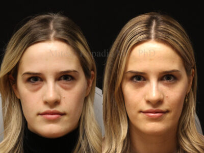 Woman in her 20s before and seven months after lower blepharoplasty surgery with mid-face filler