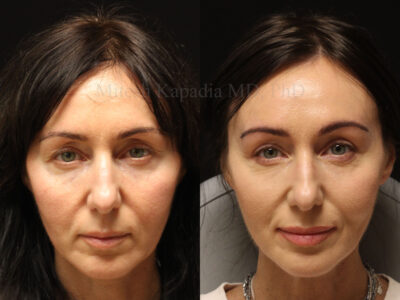 Woman in her 40s before and after upper blepharoplasty surgery giving her a well rested appearance