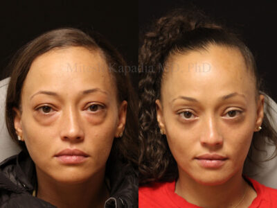 Woman in her early 30s three months after lower blepharoplasty surgery, showing a well rested, youthful appearance