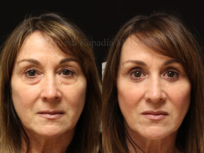 Woman in her 50s before and six months after lower blepharoplasty surgery and upper eyelid nasal fat pad sculpting