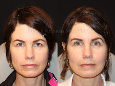 Woman in her 50s before and three months after upper blepharoplasty surgery giving her a refreshed, happier appearance
