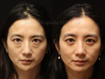 Woman in her 30s before and six months after lower blepharoplasty surgery leaving her with a refreshed, less tired appearance