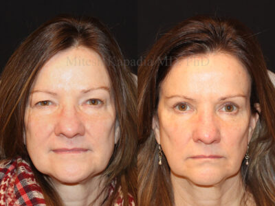 Woman in her 50s before and three months after upper and lower blepharoplasty giving a more youthful appearance