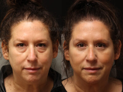 Woman in her 50s before and three months after upper and lower blepharoplasty surgery giving her a well rested youthful appearance