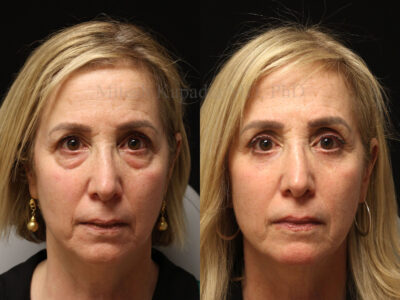 Woman in her 60s before and nine months after lower blepharoplasty surgery with lower eyelid CO2 laser resurfacing