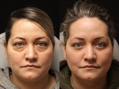 Woman in her 40s before and four months after lower blepharoplasty surgery giving her a well rested youthful appearance