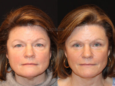 Woman in her 60s two months after upper and lower blepharoplasty surgery, drawing attention to her blue eyes as well as a well rested appearance