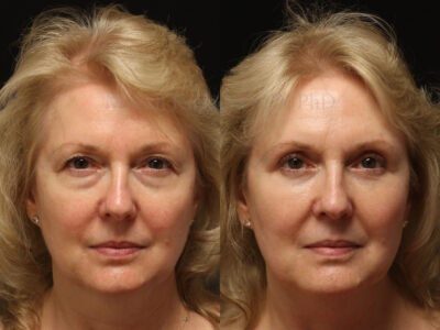 Woman in her 60s before and four months after upper and lower blepharoplasty surgery giving her a refreshed look