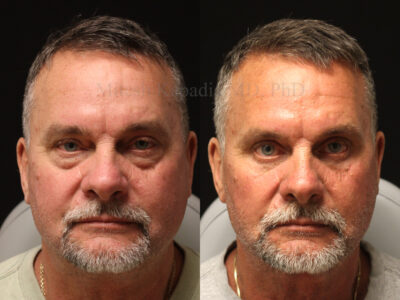 Man in his 60s before and four months after lower blepharoplasty with upper eyelid nasal fat pad removal, giving him a youthful, less tired appearance