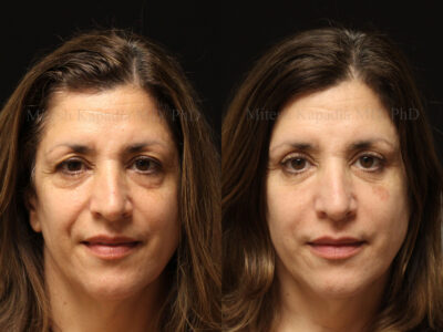 Woman in her 50s before and seven months after upper and lower blepharoplasty surgery giving her a youthful appearance