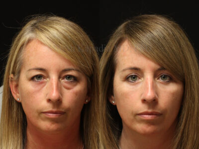 Woman in her 40s before and five months after upper and lower blepharoplasty surgery
