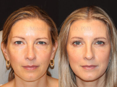 Woman in her 40s before and six months after upper and lower blepharoplasty surgery leaving her more youthful and refreshed looking