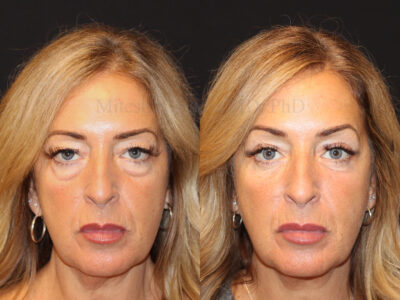 Woman in her 50s before and four months after upper and lower blepharoplasty surgery giving her a a younger and less tired look