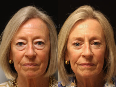 Woman in her 60s before and seven months after upper and lower blepharoplasty surgery giving her a much younger natural appearance