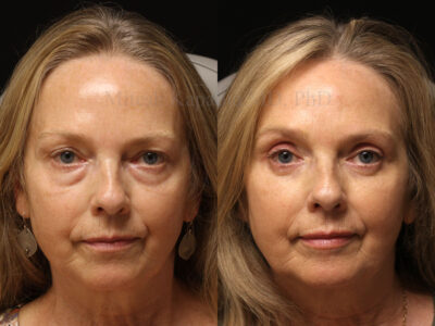 Woman in her 60s before and six months after upper and lower blepharoplasty surgery giving her a youthful less tired appearance